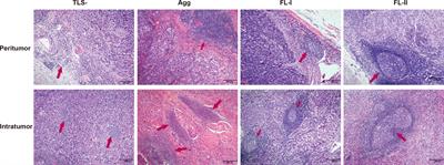 Impact of mature tertiary lymphoid structures on prognosis and therapeutic response of Epstein-Barr virus-associated gastric cancer patients